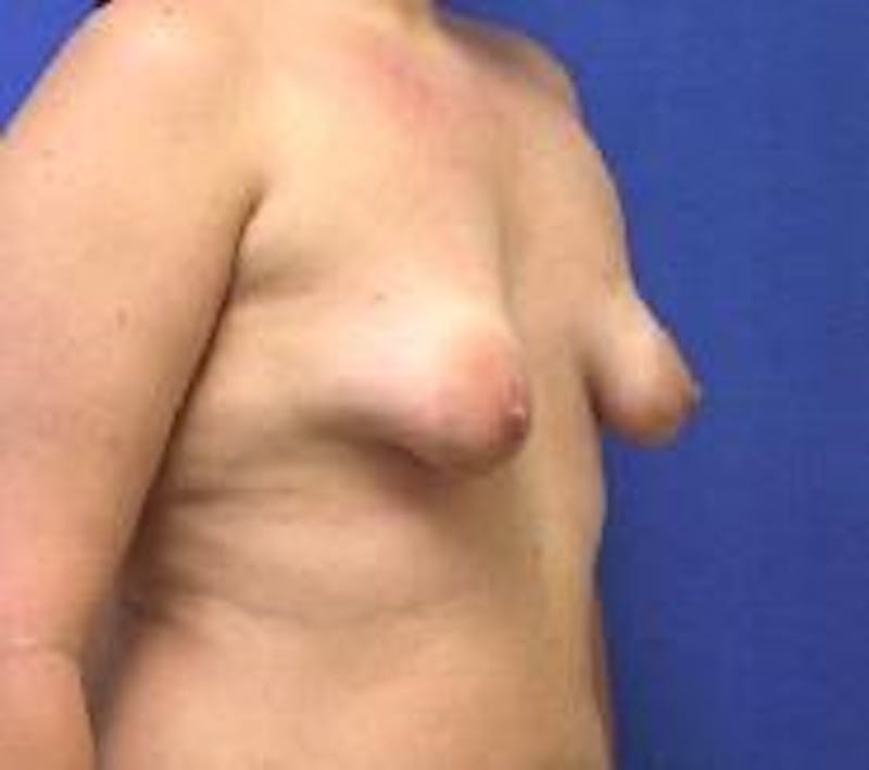 Breat Augmentation With Lift Before & After Gallery - Patient 90456901 - Image 3
