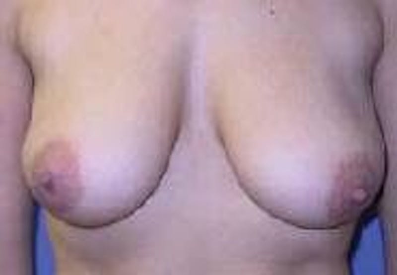 Breat Augmentation With Lift Before & After Gallery - Patient 90456903 - Image 1