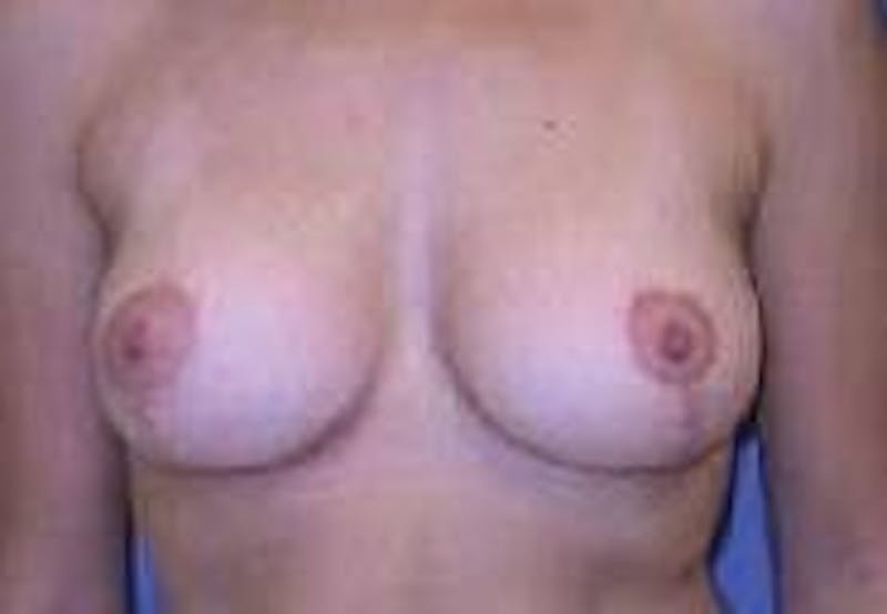 Breat Augmentation With Lift Before & After Gallery - Patient 90456903 - Image 2