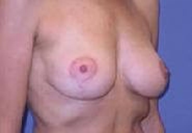 Breat Augmentation With Lift Before & After Gallery - Patient 90456903 - Image 4