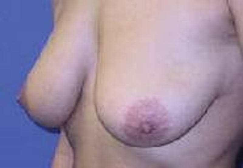 Breat Augmentation With Lift Before & After Gallery - Patient 90456903 - Image 5