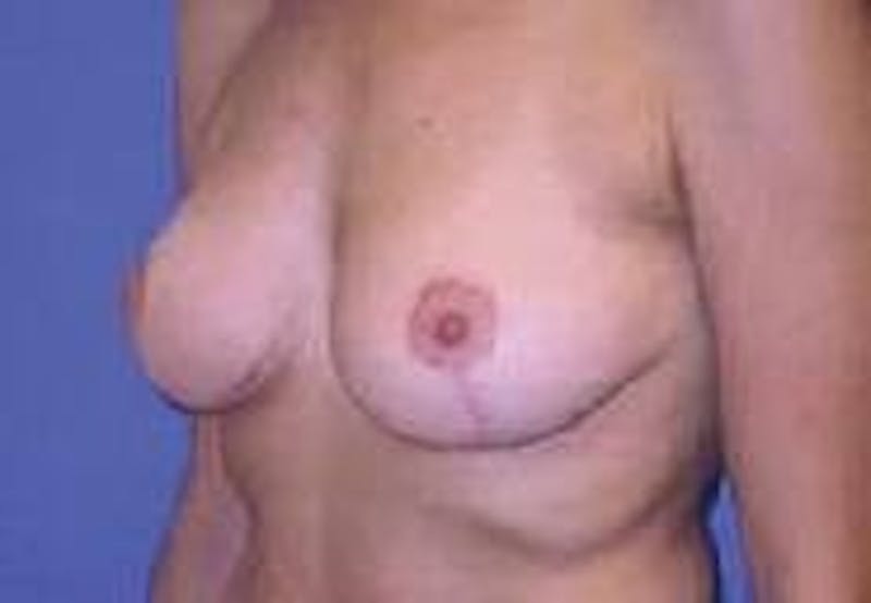 Breat Augmentation With Lift Before & After Gallery - Patient 90456903 - Image 6