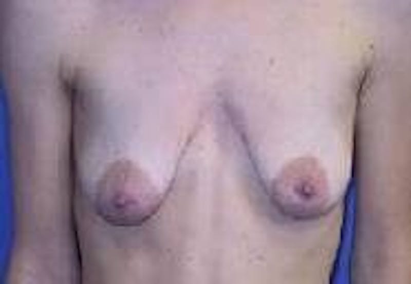 Breat Augmentation With Lift Before & After Gallery - Patient 90456911 - Image 1