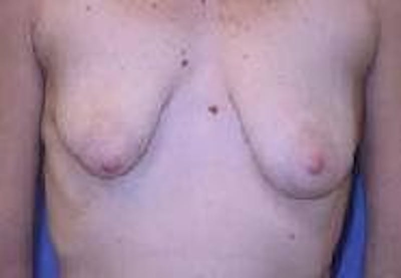 Breat Augmentation With Lift Before & After Gallery - Patient 90456913 - Image 1