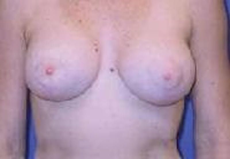 Breat Augmentation With Lift Before & After Gallery - Patient 90456913 - Image 2