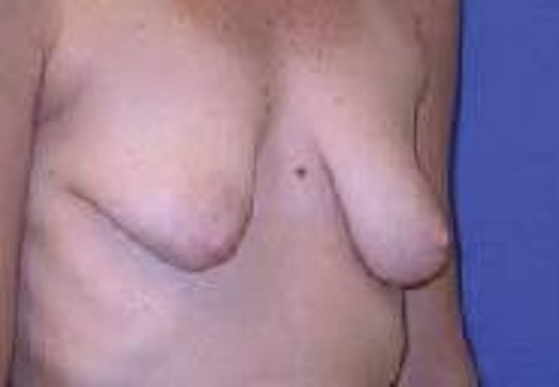 Breat Augmentation With Lift Before & After Gallery - Patient 90456913 - Image 3