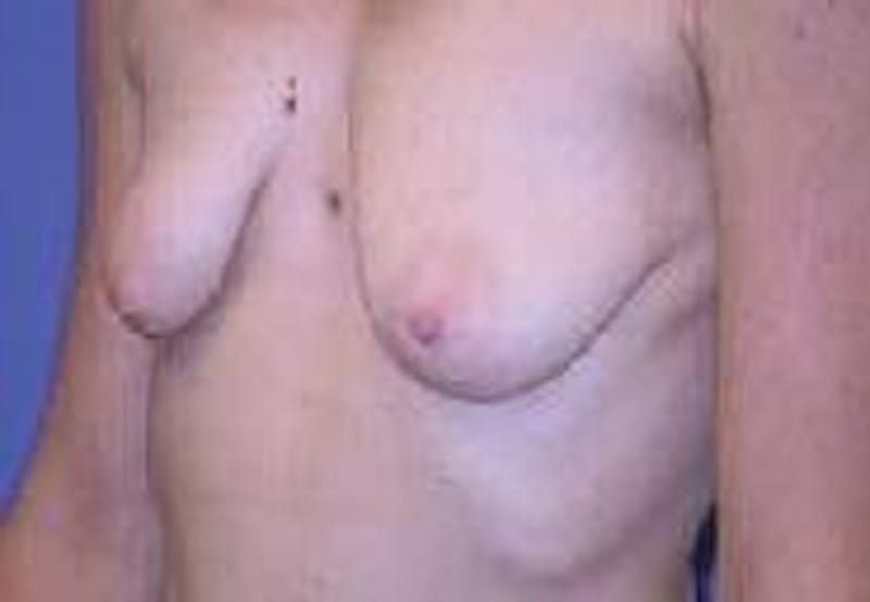 Breat Augmentation With Lift Before & After Gallery - Patient 90456913 - Image 5