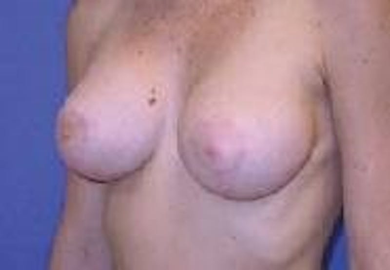 Breat Augmentation With Lift Before & After Gallery - Patient 90456913 - Image 6