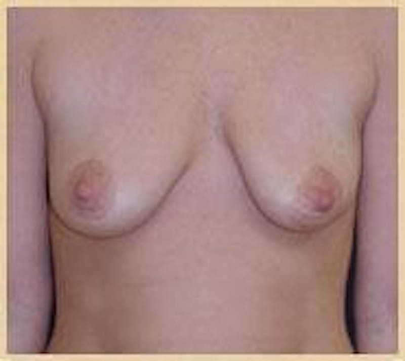 Breat Augmentation With Lift Before & After Gallery - Patient 90457161 - Image 1