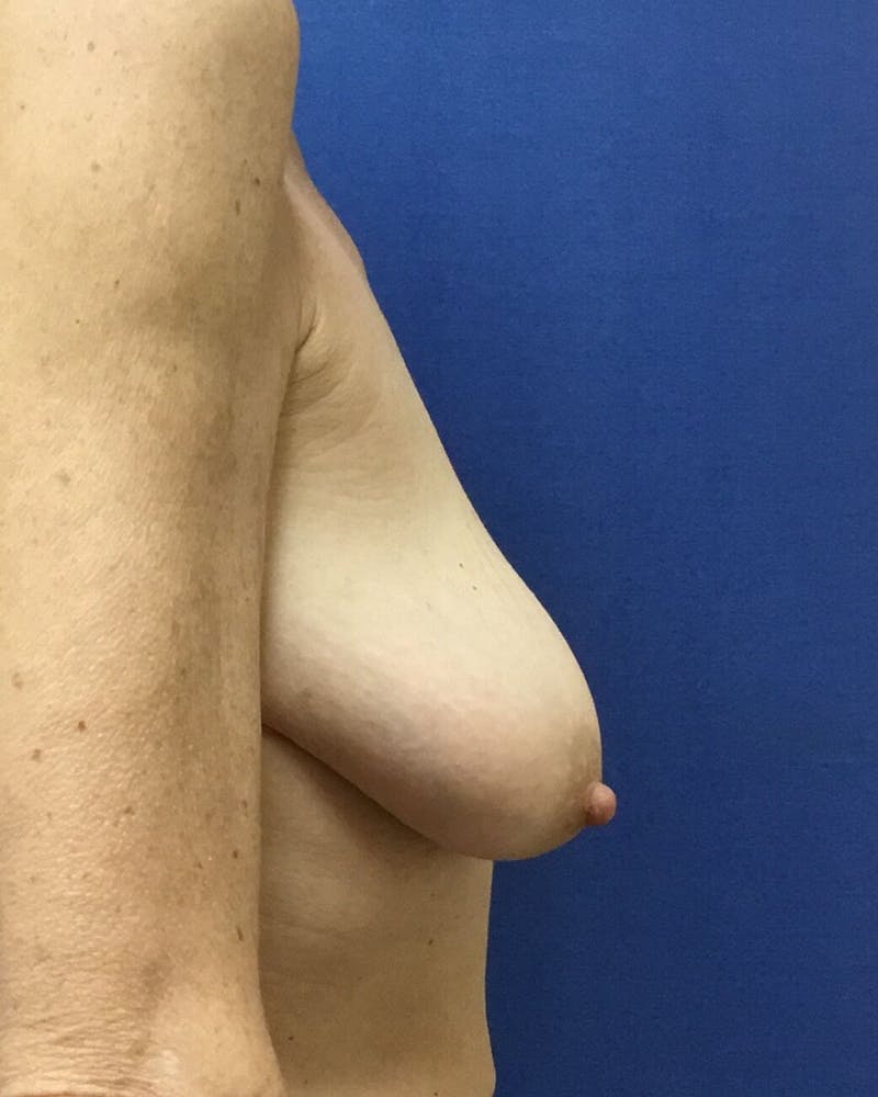 Breat Augmentation With Lift Before & After Gallery - Patient 90457163 - Image 5