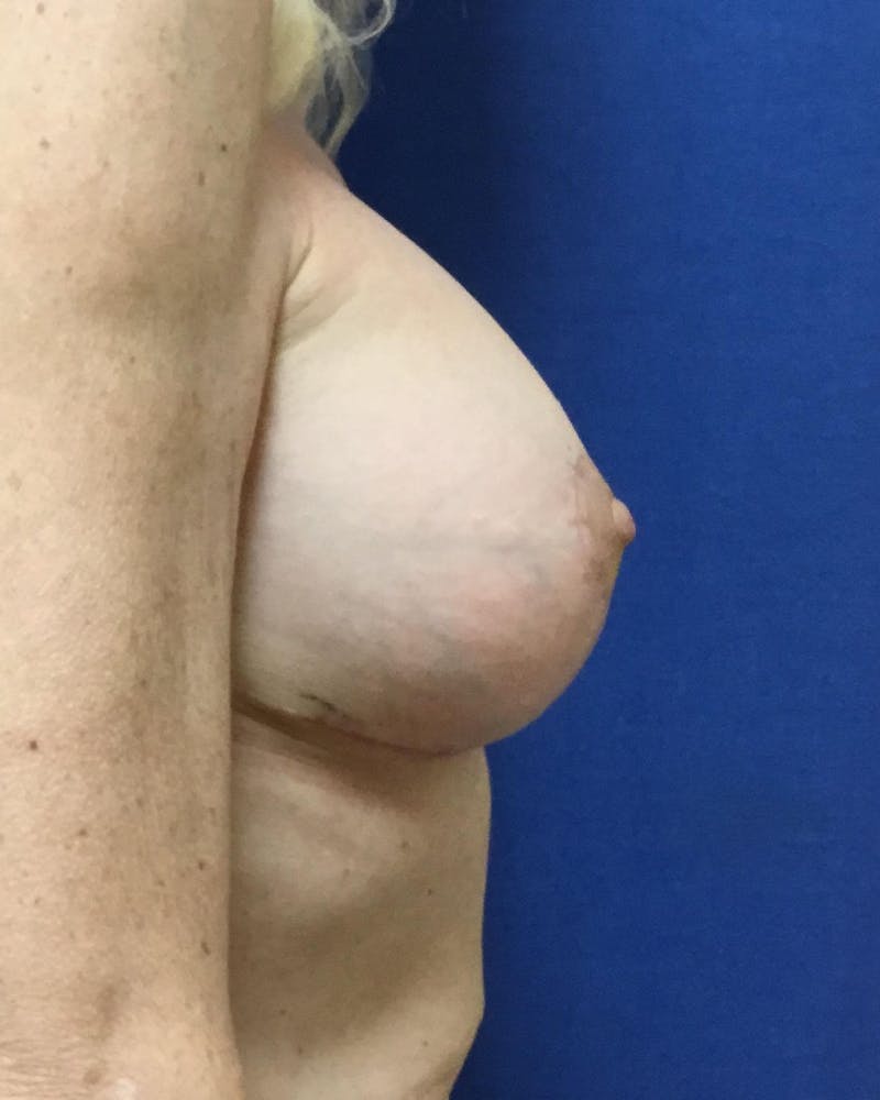 Breat Augmentation With Lift Before & After Gallery - Patient 90457163 - Image 6