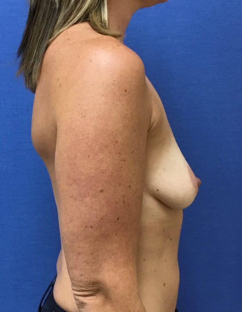 Breat Augmentation With Lift Before & After Gallery - Patient 90461872 - Image 5