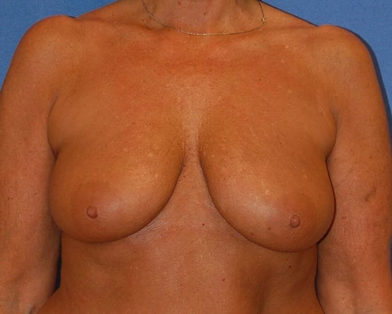 Breat Augmentation With Lift Before & After Gallery - Patient 90461882 - Image 1