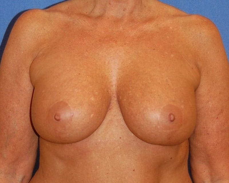 Breat Augmentation With Lift Before & After Gallery - Patient 90461882 - Image 2