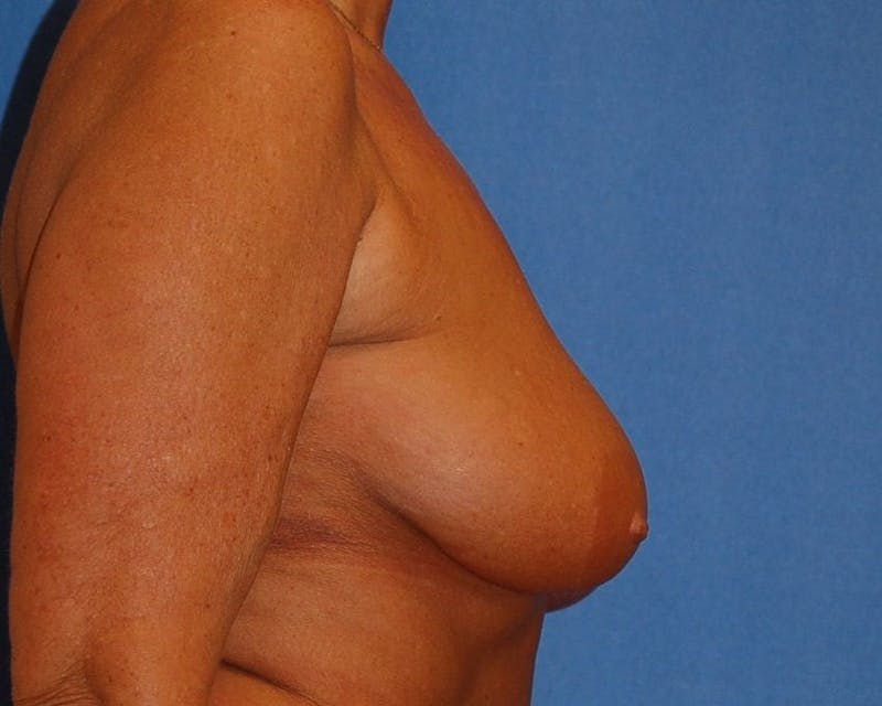 Breat Augmentation With Lift Before & After Gallery - Patient 90461882 - Image 5