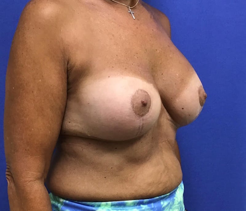 Breat Augmentation With Lift Before & After Gallery - Patient 90461885 - Image 4