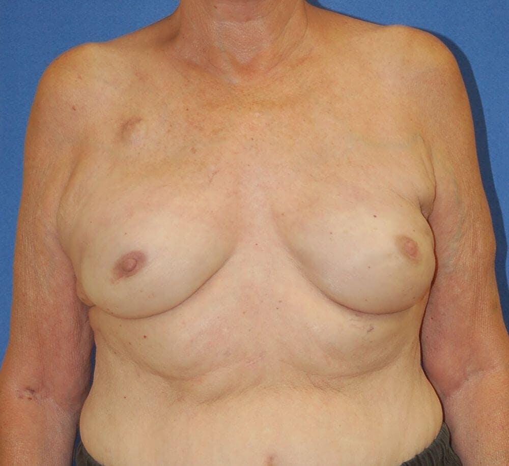 Breast Reconstruction Gallery - Patient 90463876 - Image 2