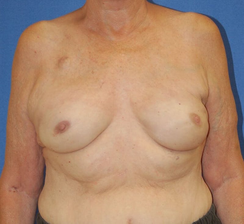 Breast Reconstruction Before & After Gallery - Patient 90463876 - Image 2