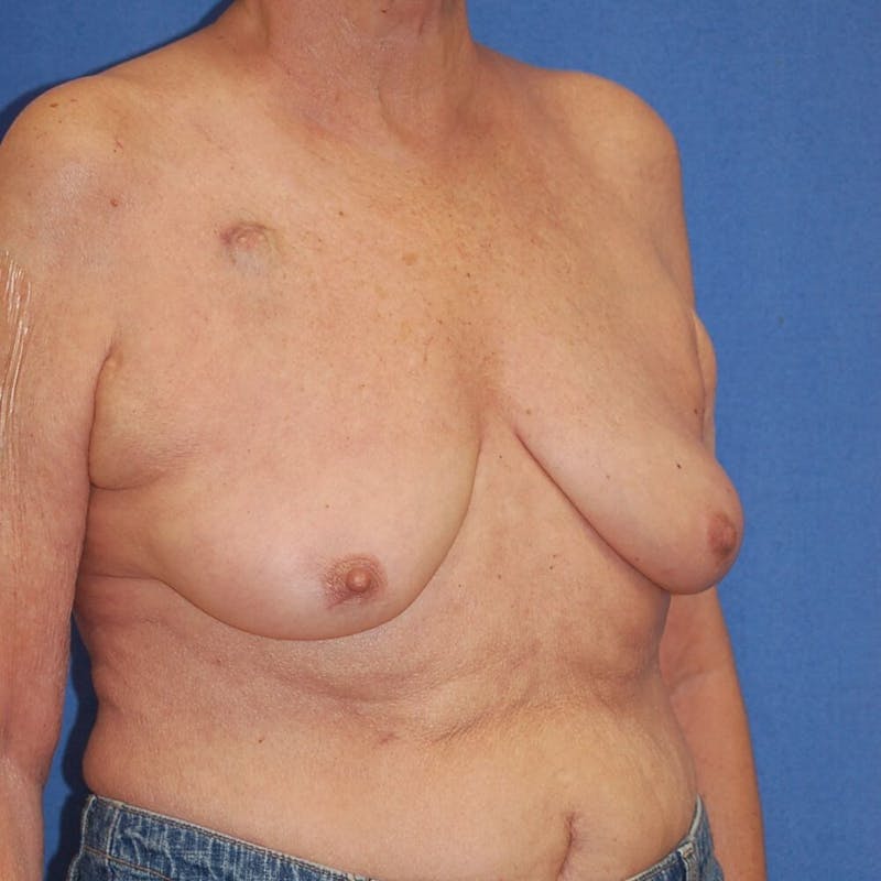 Breast Reconstruction Before & After Gallery - Patient 90463876 - Image 3