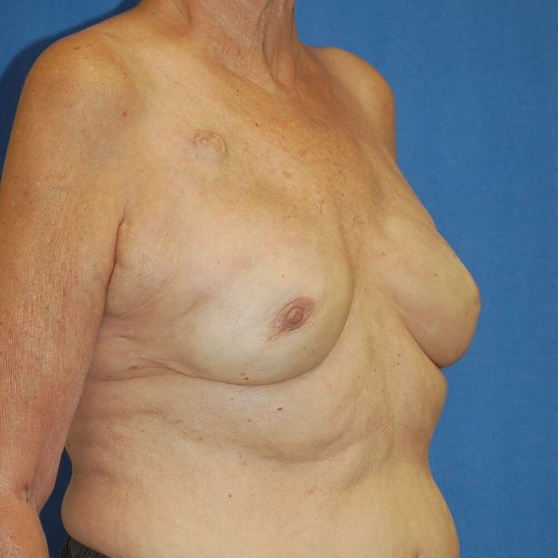 Breast Reconstruction Before & After Gallery - Patient 90463876 - Image 4