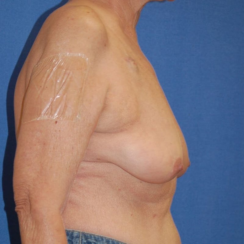 Breast Reconstruction Before & After Gallery - Patient 90463876 - Image 5
