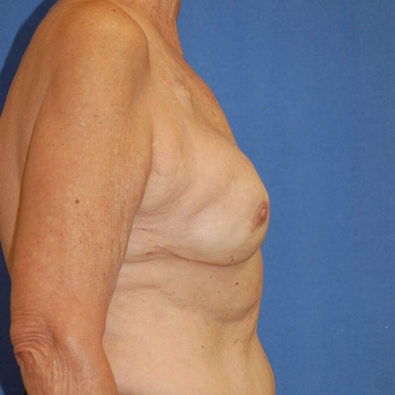 Breast Reconstruction Before & After Gallery - Patient 90463876 - Image 6