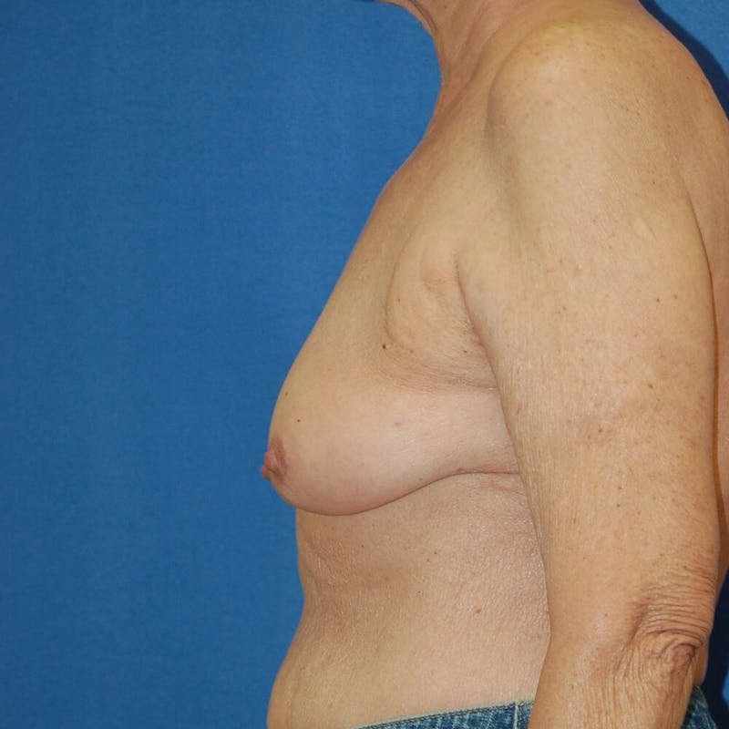 Breast Reconstruction Before & After Gallery - Patient 90463876 - Image 9