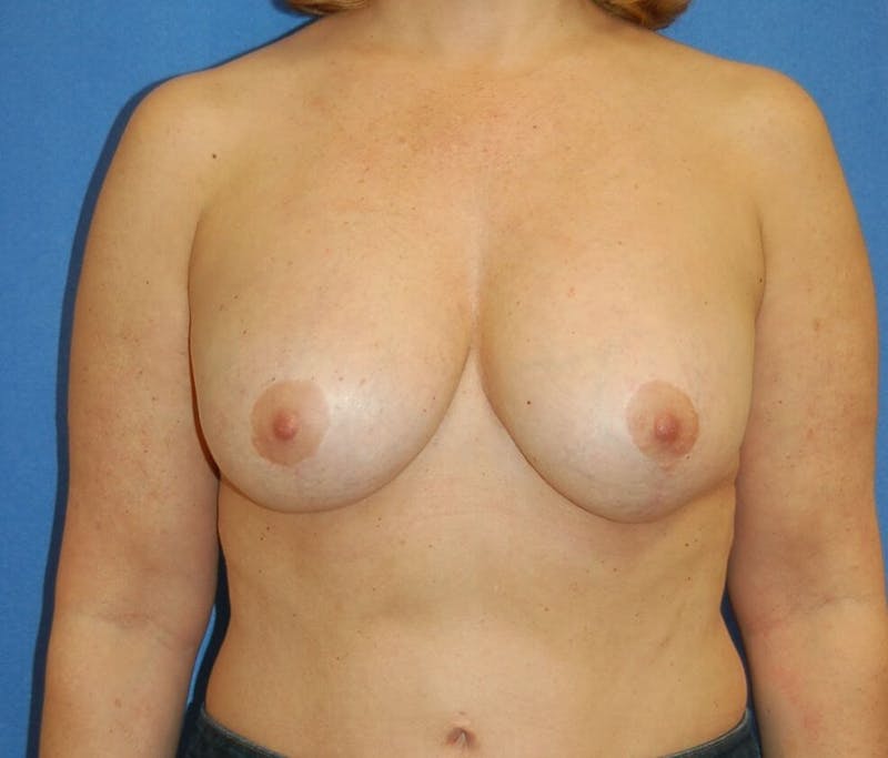 Breast Reconstruction Before & After Gallery - Patient 90463898 - Image 1