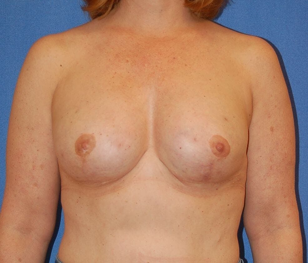 Breast Reconstruction Gallery - Patient 90463898 - Image 2
