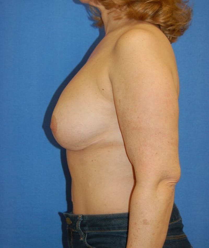 Breast Reconstruction Before & After Gallery - Patient 90463898 - Image 9