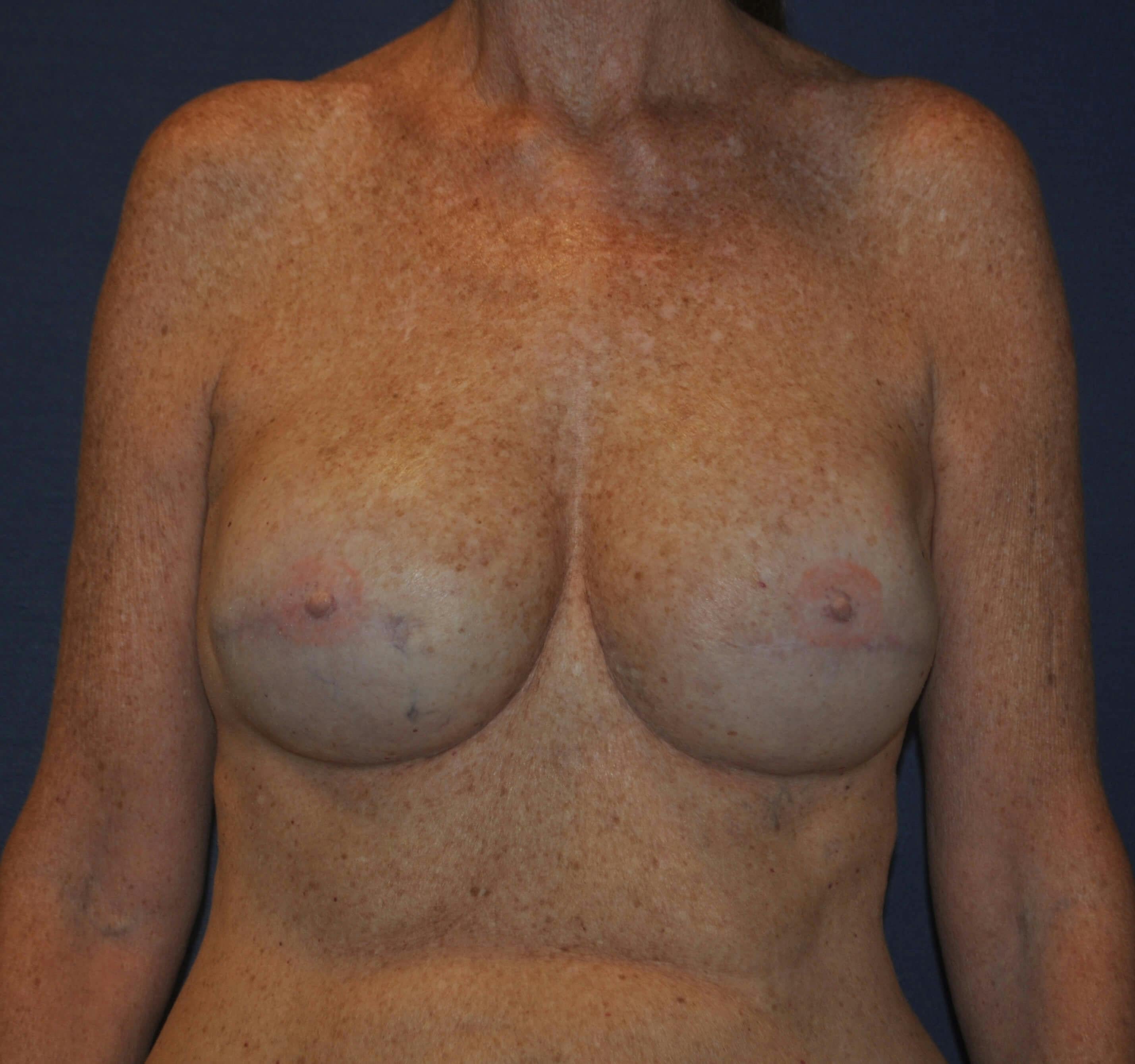 Breast Reconstruction Gallery - Patient 90463948 - Image 2