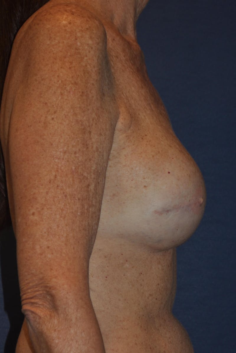 Breast Reconstruction Before & After Gallery - Patient 90463948 - Image 6