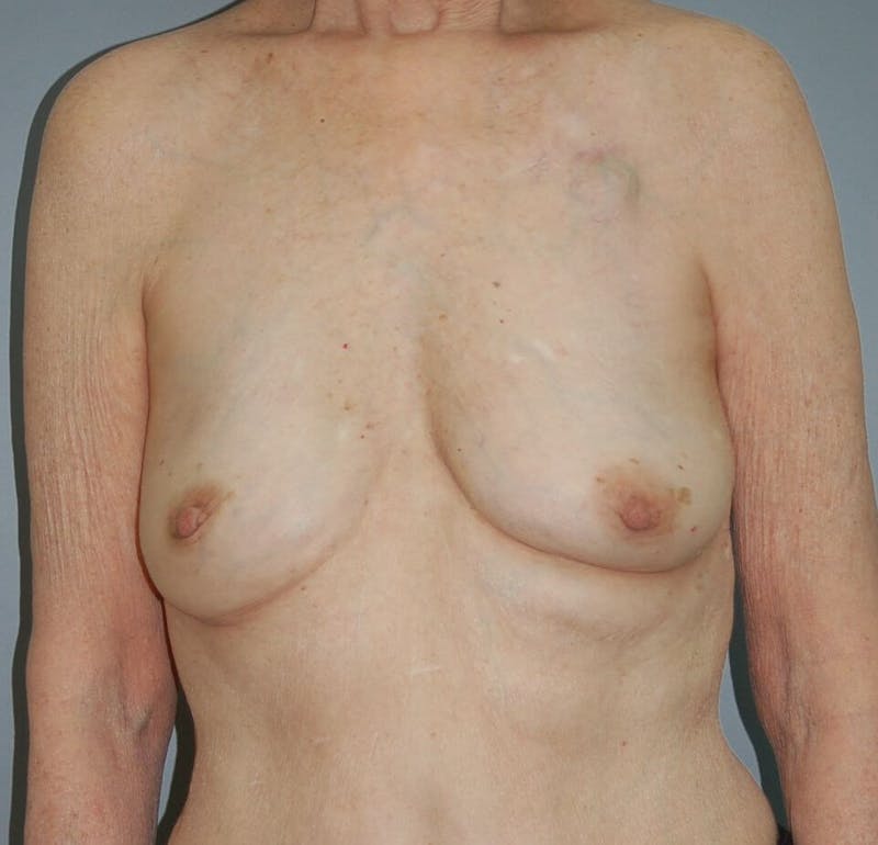 Breast Reconstruction Before & After Gallery - Patient 90463967 - Image 1
