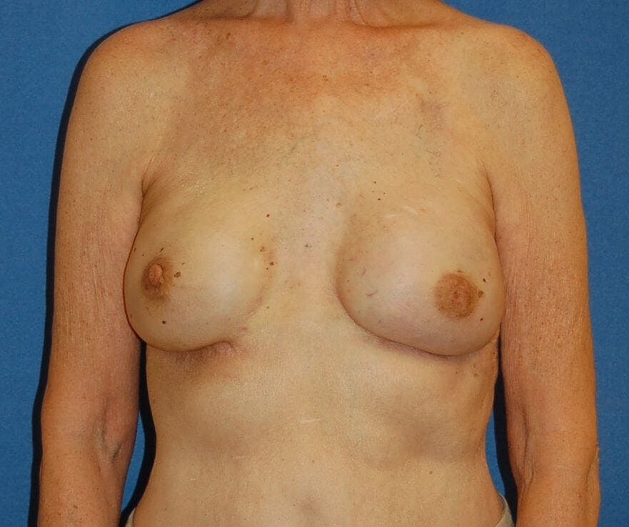 Breast Reconstruction Gallery - Patient 90463967 - Image 2