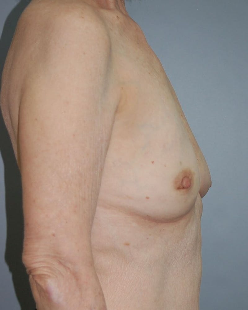 Breast Reconstruction Before & After Gallery - Patient 90463967 - Image 3