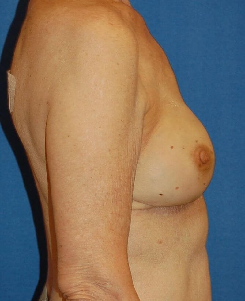 Breast Reconstruction Before & After Gallery - Patient 90463967 - Image 4