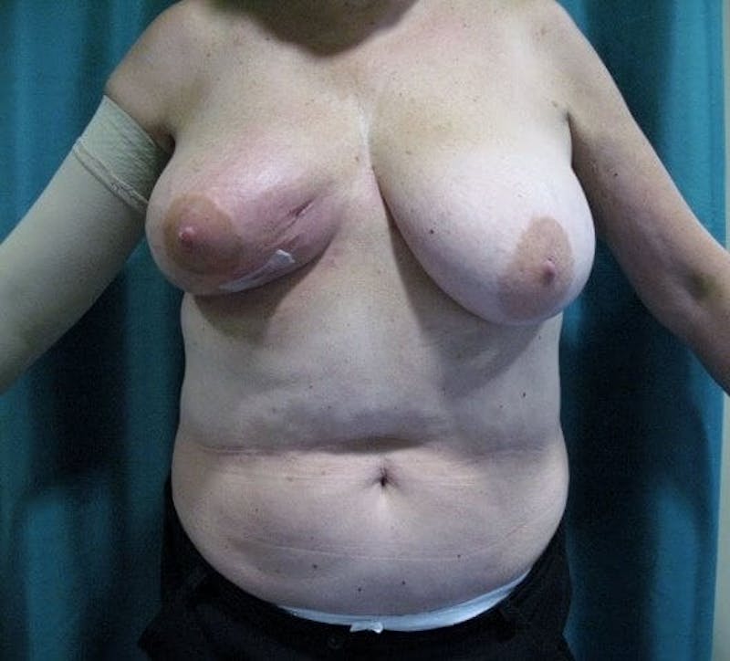Breast Reconstruction Before & After Gallery - Patient 90463983 - Image 1
