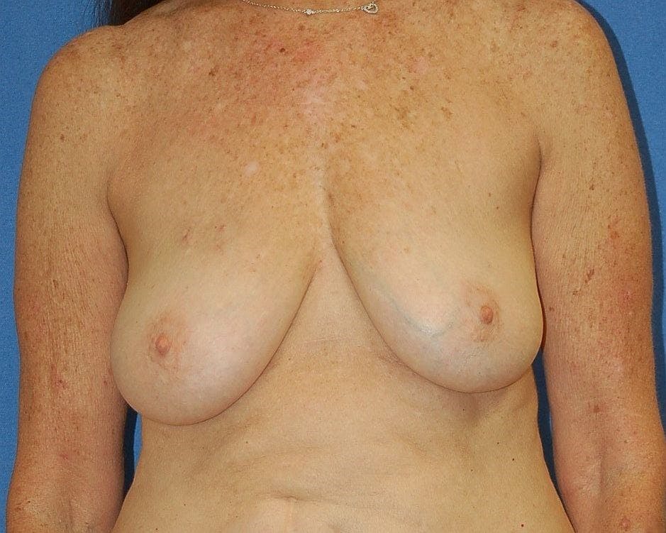 Breast Reconstruction Gallery - Patient 90463999 - Image 1