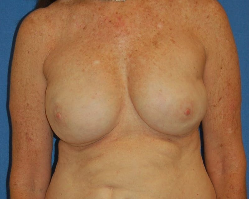 Breast Reconstruction Before & After Gallery - Patient 90463999 - Image 2