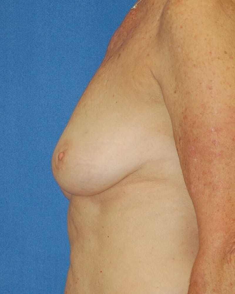 Breast Reconstruction Before & After Gallery - Patient 90463999 - Image 5