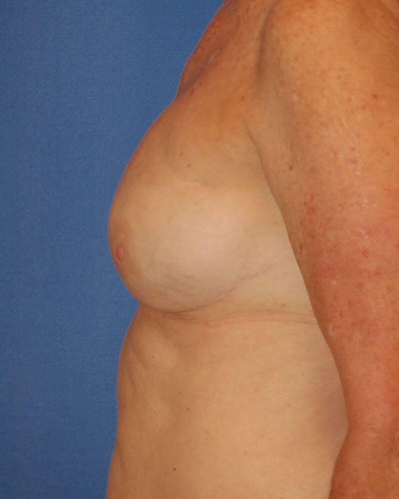Breast Reconstruction Before & After Gallery - Patient 90463999 - Image 6