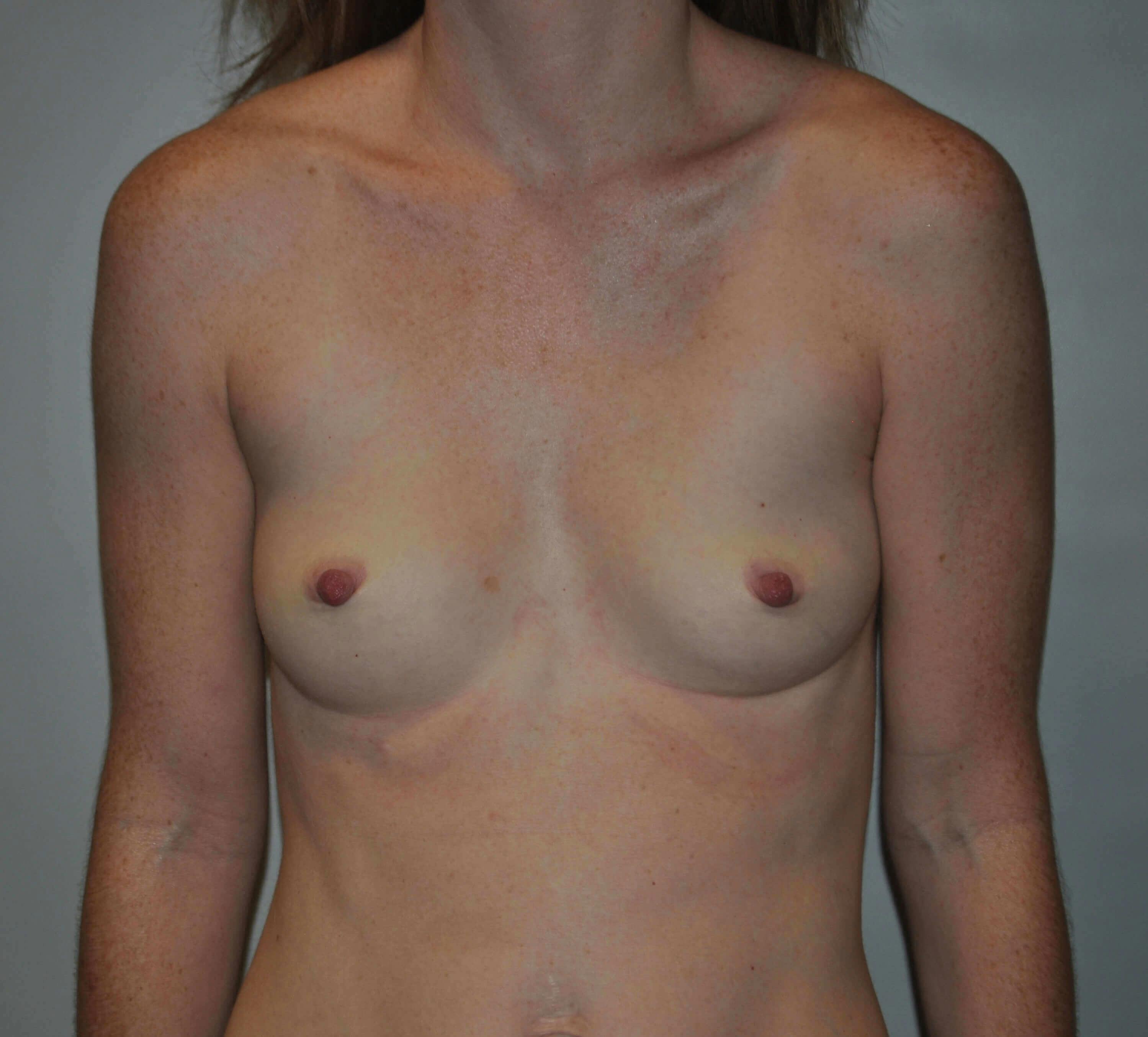 Breast Reconstruction Gallery - Patient 90468549 - Image 1