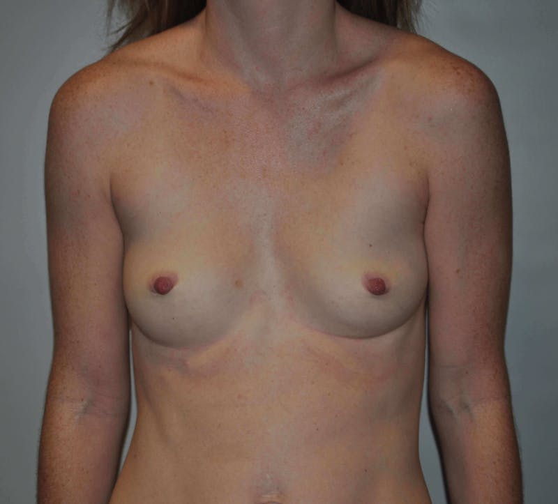 Breast Reconstruction Before & After Gallery - Patient 90468549 - Image 1