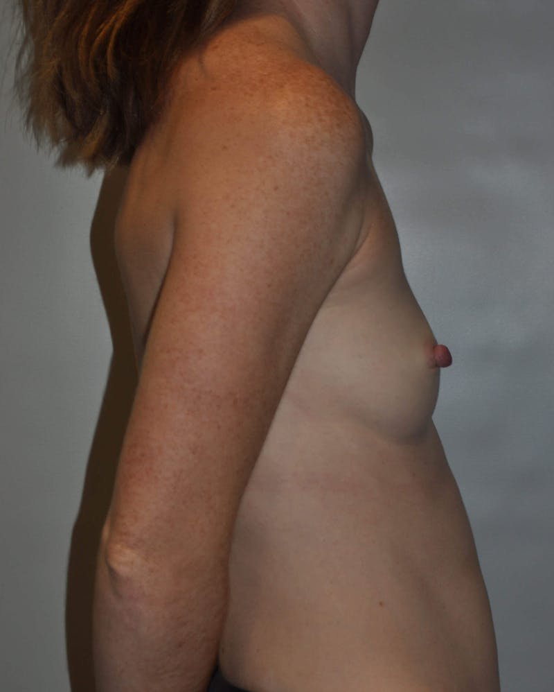 Breast Reconstruction Before & After Gallery - Patient 90468549 - Image 5