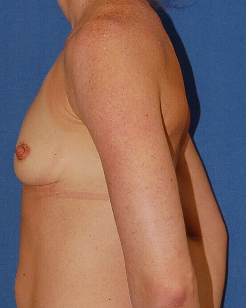Breast Reconstruction Gallery - Patient 90474618 - Image 5