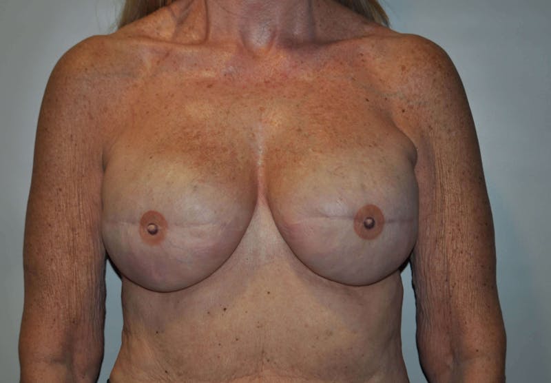 Breast Reconstruction Before & After Gallery - Patient 90474644 - Image 1