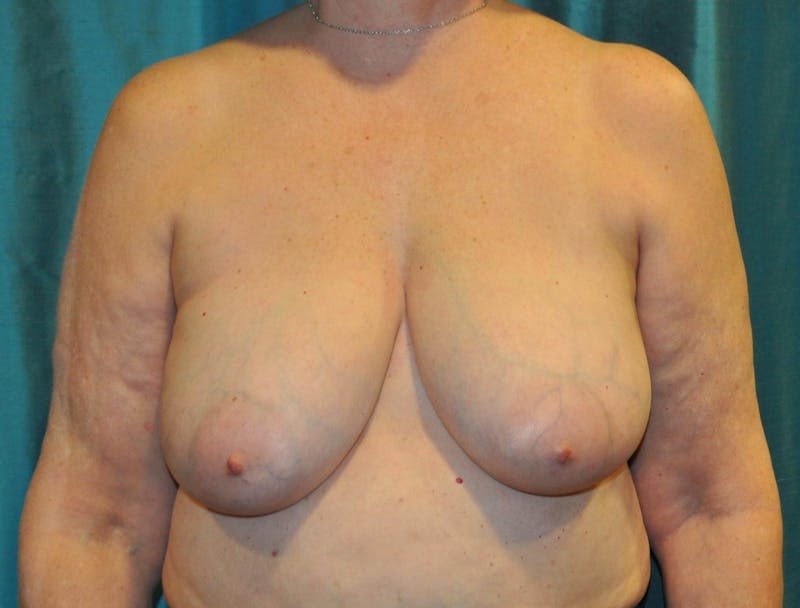 Breast Reconstruction Before & After Gallery - Patient 90474657 - Image 1