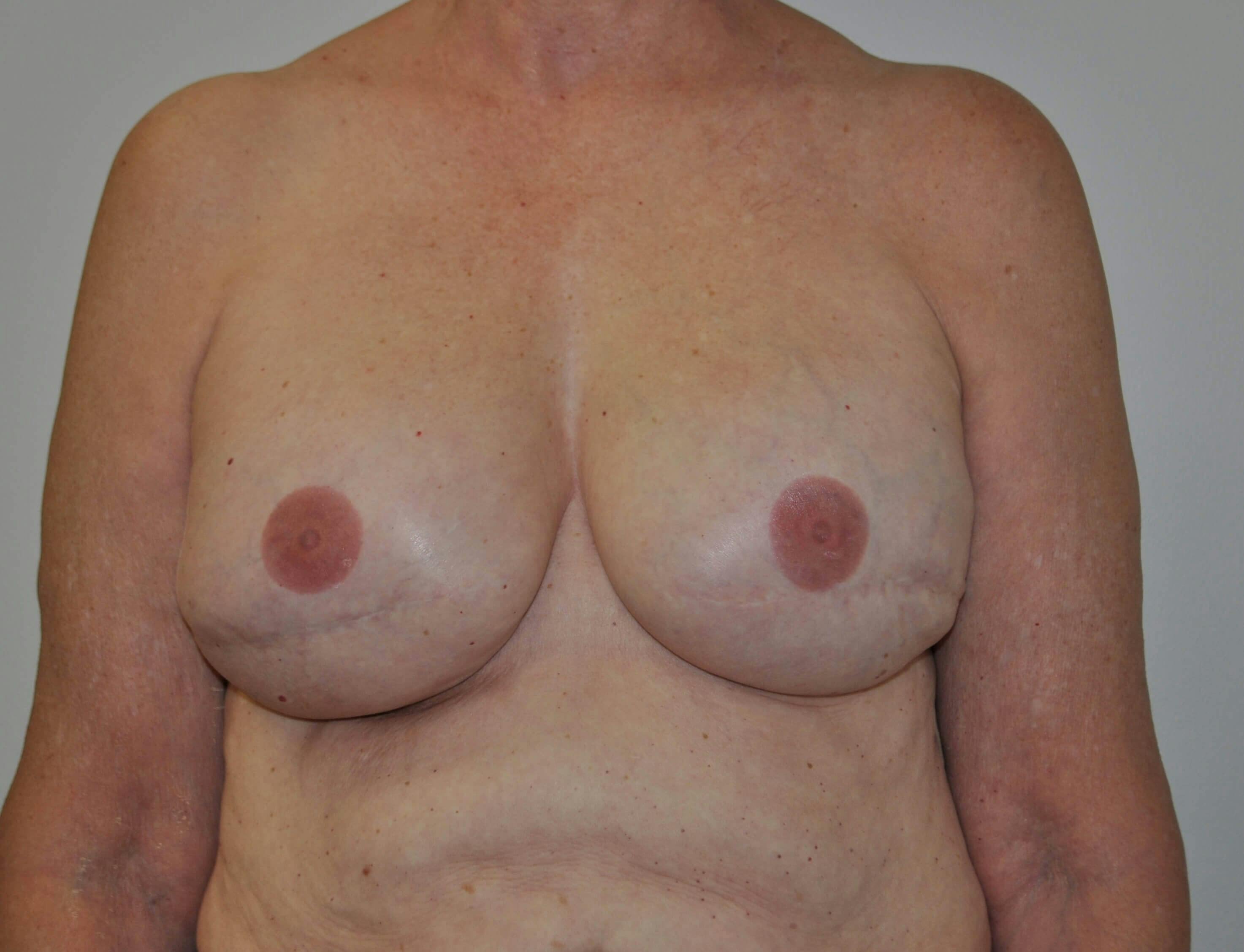 Breast Reconstruction Gallery - Patient 90474657 - Image 2