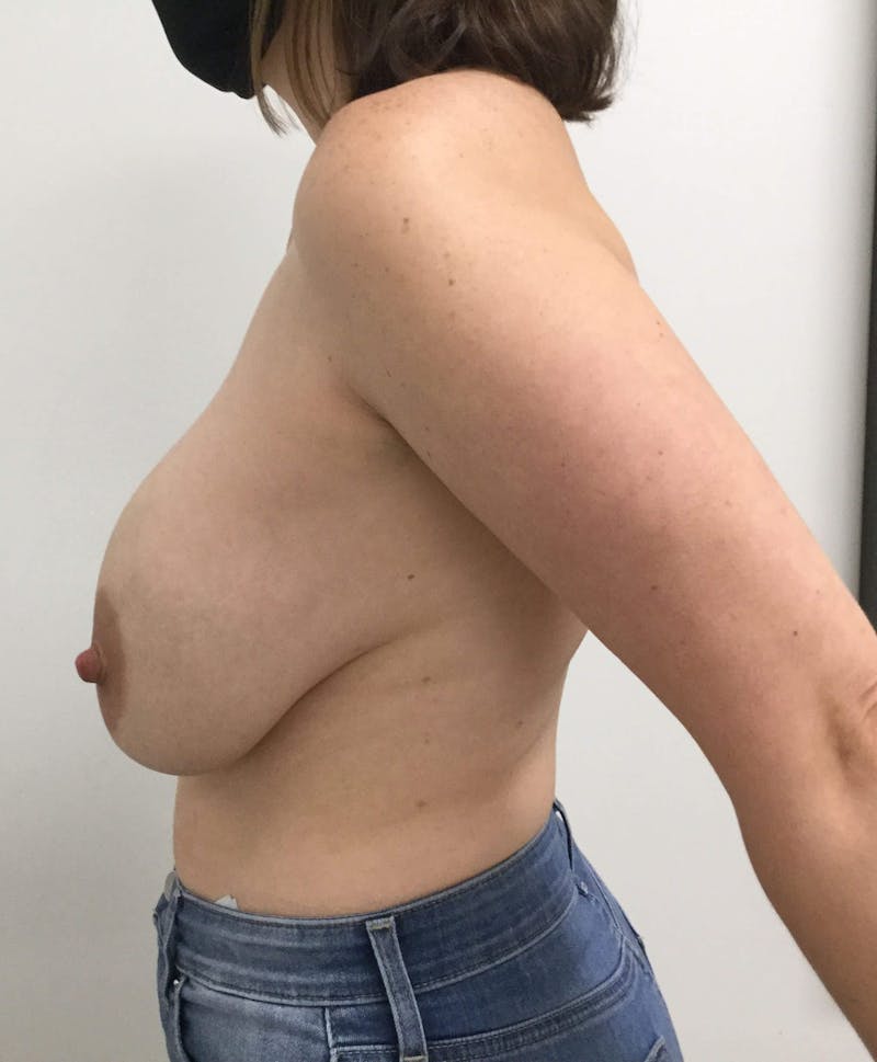 Breast Revision Before & After Gallery - Patient 91458875 - Image 3