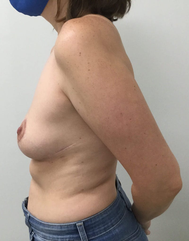 Breast Revision Before & After Gallery - Patient 91458875 - Image 4